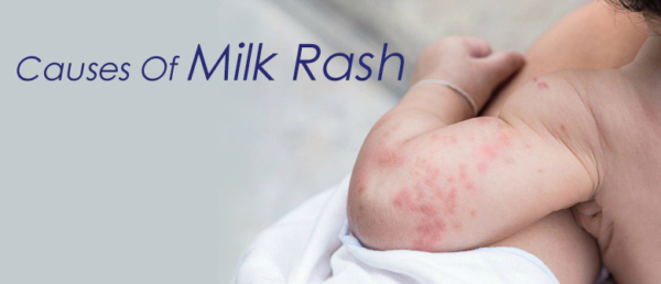 causes-of-milk-rash-cussons-baby-nigeria