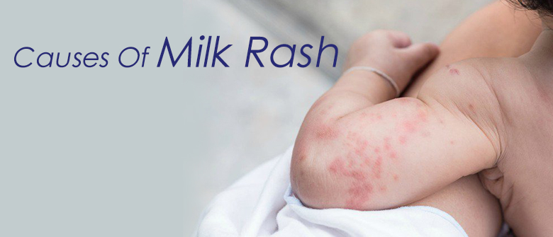 allergic reaction rash baby